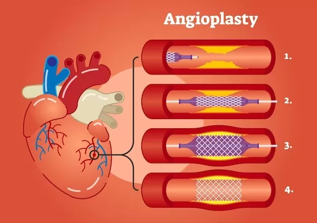 Types of Stents Used in Angioplasty